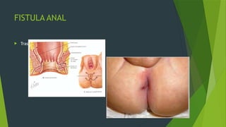 FISTULA ANAL
 Tras episodios de abceso perianal.
 