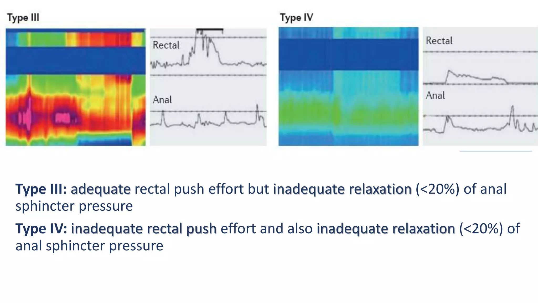 Type III: adequate rectal push effort but inadequate relaxation (<20%) of anal
sphincter pressure
Type IV: inadequate rectal push effort and also inadequate relaxation (<20%) of
anal sphincter pressure
 
