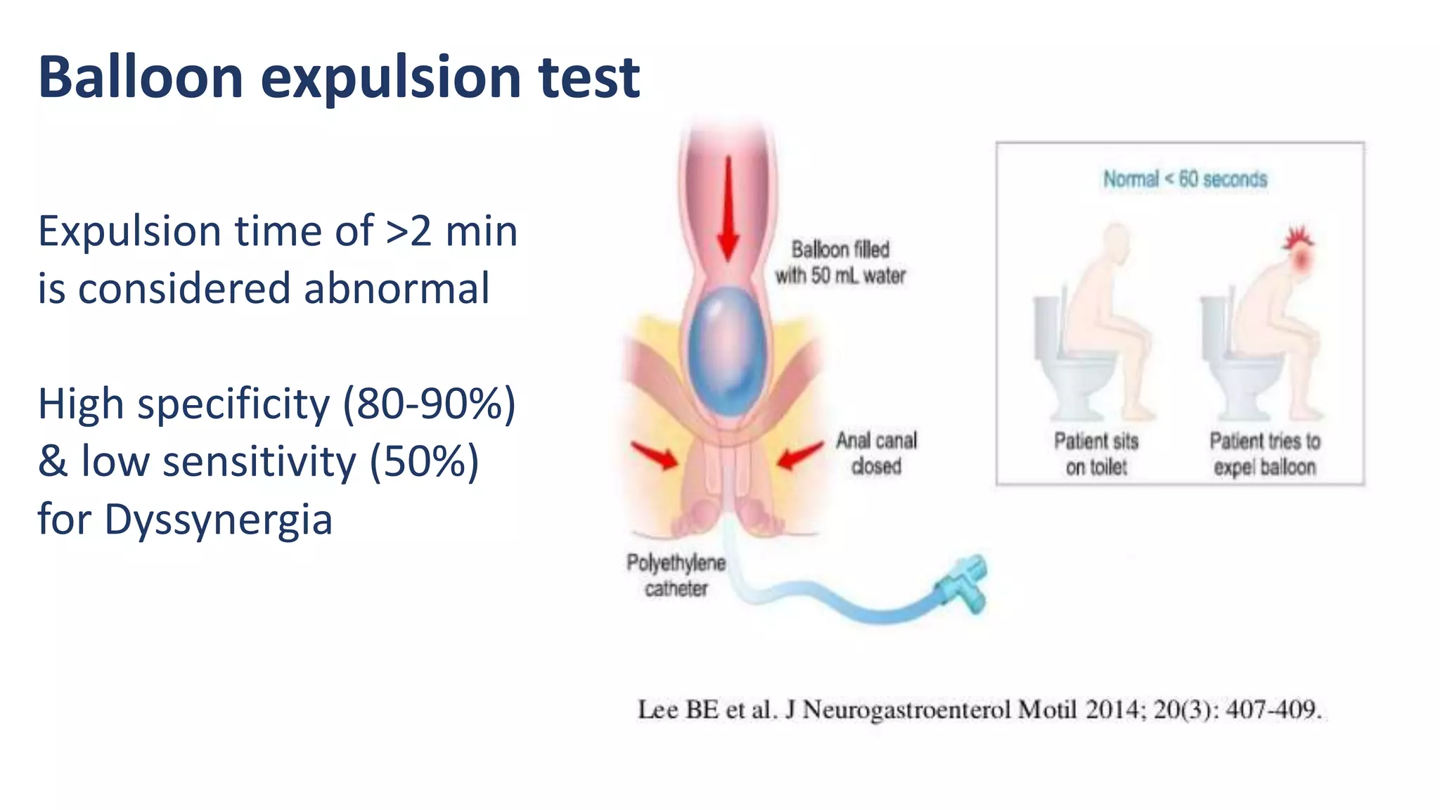 Balloon expulsion test
Expulsion time of >2 min
is considered abnormal
High specificity (80-90%)
& low sensitivity (50%)
for Dyssynergia
 