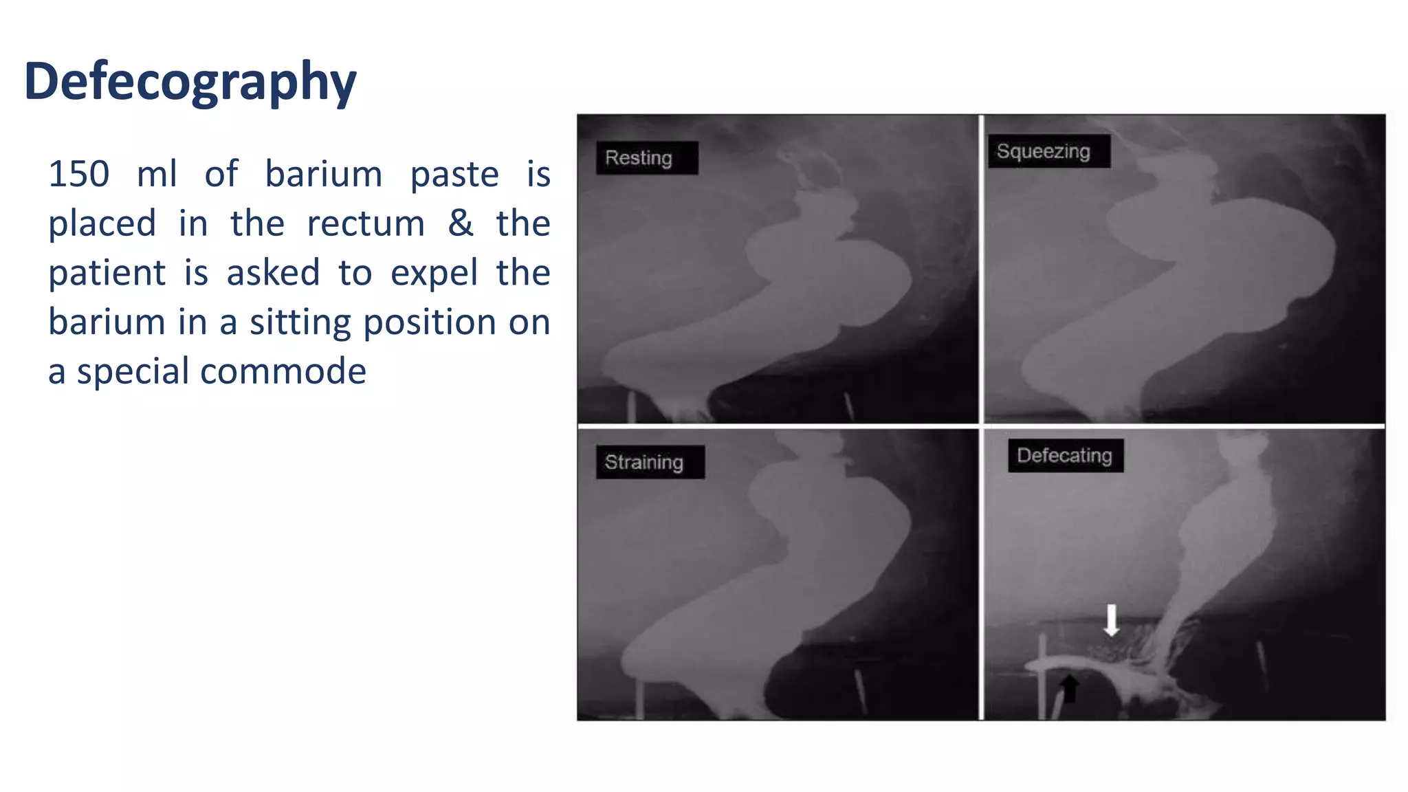Defecography
150 ml of barium paste is
placed in the rectum & the
patient is asked to expel the
barium in a sitting position on
a special commode
 
