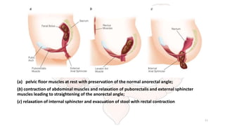 (a) pelvic floor muscles at rest with preservation of the normal anorectal angle;
(b) contraction of abdominal muscles and relaxation of puborectalis and external sphincter
muscles leading to straightening of the anorectal angle;
(c) relaxation of internal sphincter and evacuation of stool with rectal contraction
11
 