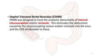 • Stapled Transanal Rectal Resection (STARR)
STARR was designed to treat the anatomic abnormality of internal
intussusception and/or rectocele . This eliminates the obstruction
caused by the intussuscepting rectum and/or rectocele into the anus
and the ODS attributable to these.
51
 