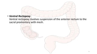 • Ventral Rectopexy
Ventral rectopexy involves suspension of the anterior rectum to the
sacral promontory with mesh.
52
 