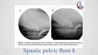 Spastic pelvic floor $
 