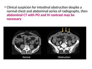 • Clinical suspicion for intestinal obstruction despite a
normal chest and abdominal series of radiographs, then
abdominal CT with PO and IV contrast may be
necessary
 