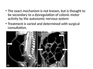 • The exact mechanism is not known, but is thought to
be secondary to a dysregulation of colonic motor
activity by the autonomic nervous system
• Treatment is varied and determined with surgical
consultation.
 