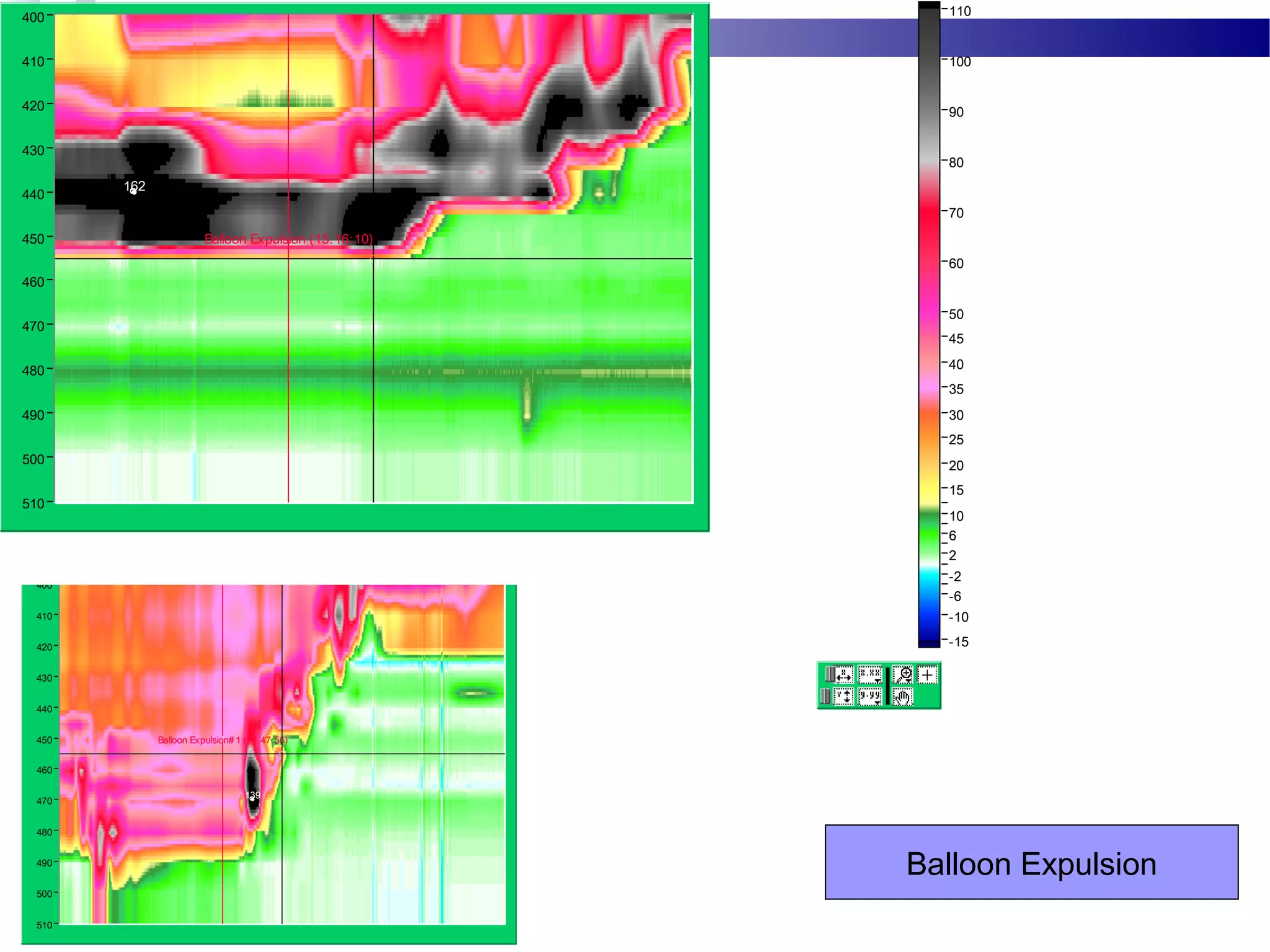 110
-15
-10
-6
-2
2
6
10
15
20
25
30
35
40
45
50
60
70
80
90
100
510
400
410
420
430
440
450
460
470
480
490
500
162
Balloon Expulsion (15.16:10)
Balloon Expulsion
110
6
10
15
20
25
30
35
40
45
50
60
70
80
90
100
510
400
410
420
430
440
450
460
470
480
490
500
139
Balloon Expulsion# 1 (14.47:56)
 