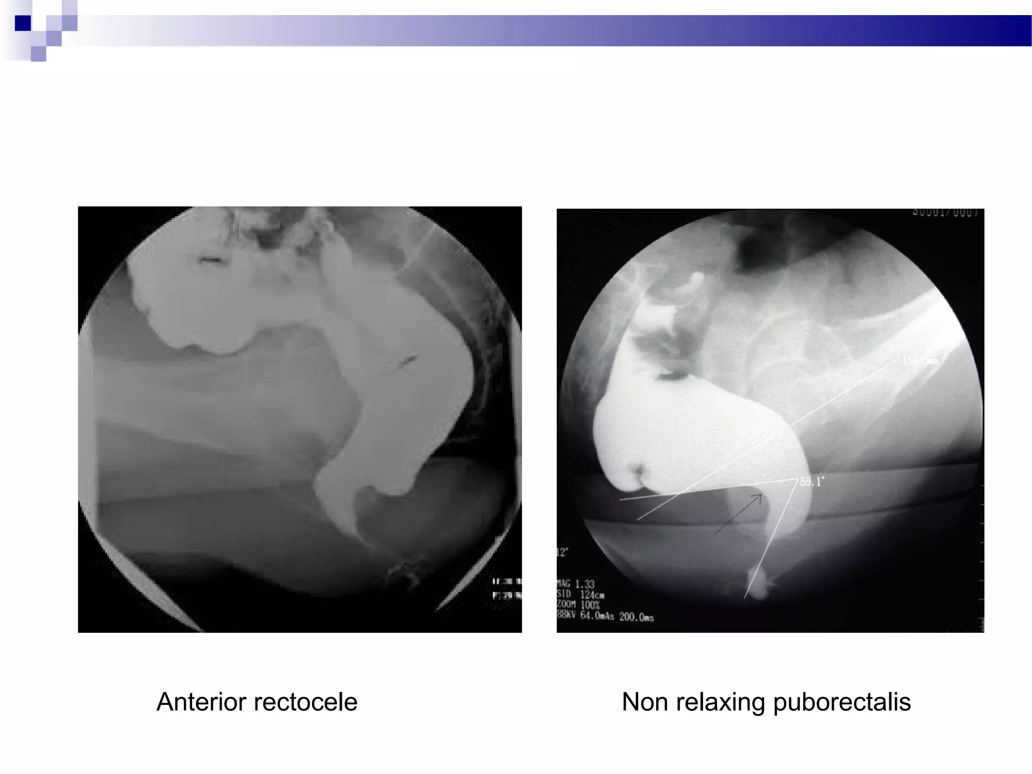 Anterior rectocele Non relaxing puborectalis
 