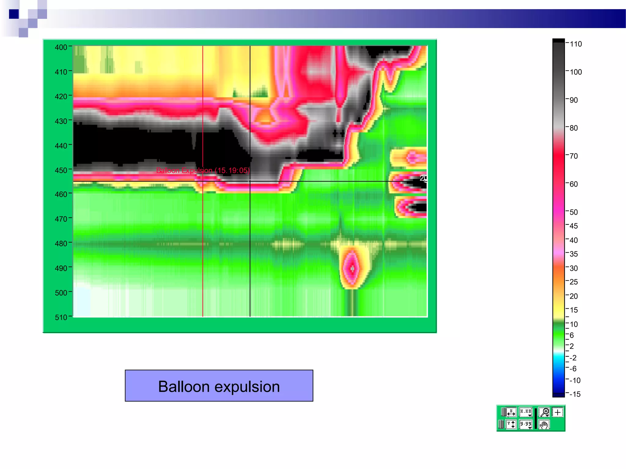 110
-15
-10
-6
-2
2
6
10
15
20
25
30
35
40
45
50
60
70
80
90
100
510
400
410
420
430
440
450
460
470
480
490
500
206
Balloon Expulsion (15.19:05)
Balloon expulsion
 