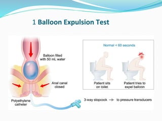 1 Balloon Expulsion Test
 