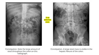 Constipation for undergraduate medical students.pptx