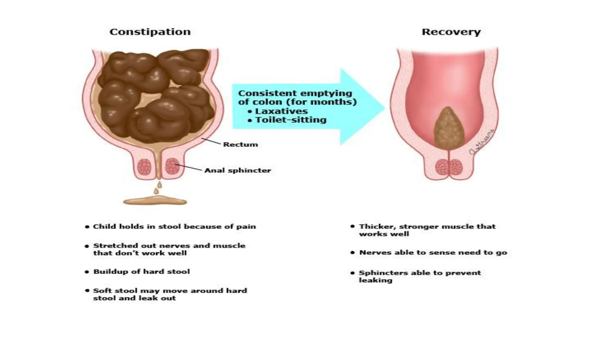 CONSTIPATION IN CHILDREN 2021 Pediatrics.pdf