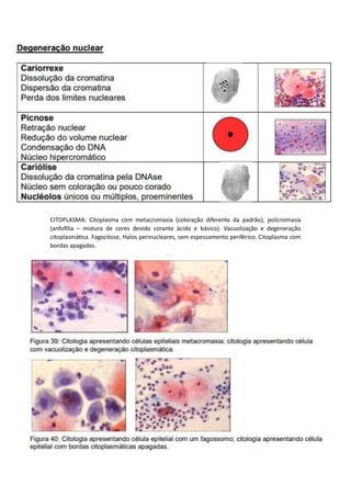 CITOPLASMA: Citoplasma com metacromasia (coloração diferente da padrão), policromasia
(anfofilia – mistura de cores devido corante àcido e básico). Vacuolização e degeneração
citoplasmática. Fagocitose, Halos perinucleares, sem espessamento periférico. Citoplasma com
bordas apagadas.
 