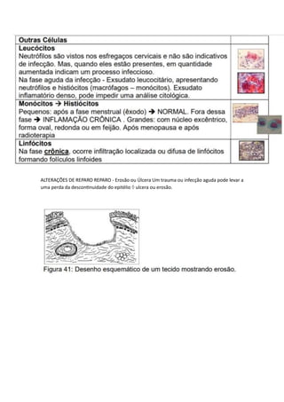 ALTERAÇÕES DE REPARO REPARO - Erosão ou Úlcera Um trauma ou infecção aguda pode levar a
uma perda da descontinuidade do epitélio  ulcera ou erosão.
 