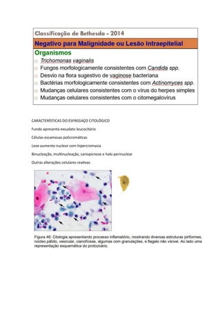 CARACTERÍSTICAS DO ESFREGAÇO CITOLÓGICO
Fundo apresenta exsudato leucocitário
Células escamosas policromáticas
Leve aumento nuclear com hipercromasia
Binucleação, multinucleação, cariopicnose e halo perinuclear
Outras alterações celulares reativas
 