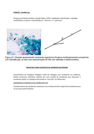FUNGOS : Candida ssp.
Fungos com blastoconideos, pseudo-hifas e hifas verdadeiras ramificadas e septadas,
eosinofilicas a marron- acinzentadas (C. albicans e C. glabrata)
DESVIO NA FLORA SUGESTIVO DE VAGINOSE BACTERIANA
Características do esfregaço citológico Fundo do esfregaço com cocobacilos em evidência.
Células escamosas individuais cobertas por uma camada de cocobacilos que obscurece a
membrana celular e o citoplasma formando as “clue cells” ou células alvo.
GARDNERELLA VAGINALIS E/OU MOBILUNCUS SP
A predominância de cocobacilos representa uma mudança da flora vaginal de Lactobacilos para
um processo polimicrobiano.
 