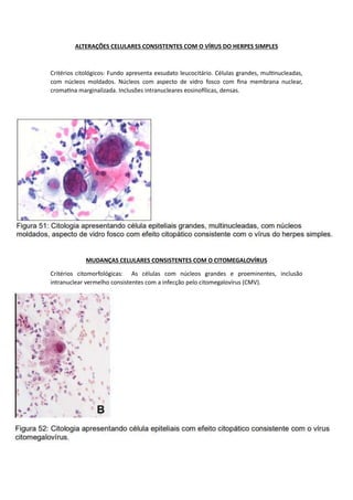 ALTERAÇÕES CELULARES CONSISTENTES COM O VÍRUS DO HERPES SIMPLES
Critérios citológicos: Fundo apresenta exsudato leucocitário. Células grandes, multinucleadas,
com núcleos moldados. Núcleos com aspecto de vidro fosco com fina membrana nuclear,
cromatina marginalizada. Inclusões intranucleares eosinofílicas, densas.
MUDANÇAS CELULARES CONSISTENTES COM O CITOMEGALOVÍRUS
Critérios citomorfológicas: As células com núcleos grandes e proeminentes, inclusão
intranuclear vermelho consistentes com a infecção pelo citomegalovírus (CMV).
 