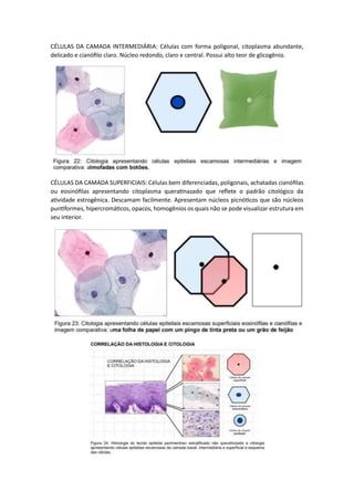 CÉLULAS DA CAMADA INTERMEDIÁRIA: Células com forma poligonal, citoplasma abundante,
delicado e cianófilo claro. Núcleo redondo, claro e central. Possui alto teor de glicogênio.
CÉLULAS DA CAMADA SUPERFICIAIS: Células bem diferenciadas, poligonais, achatadas cianófilas
ou eosinófilas apresentando citoplasma queratinazado que reflete o padrão citológico da
atividade estrogênica. Descamam facilmente. Apresentam núcleos picnóticos que são núcleos
puntiformes, hipercromáticos, opacos, homogênios os quais não se pode visualizar estrutura em
seu interior.
 
