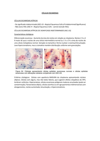 CÉLULAS ESCAMOSAS
CÉLULAS ESCAMOSAS ATÍPICAS
- De significado indeterminado (ASC-US - Atypical Squamous Cells of Undetermined Significance)
- Não exclui HSIL (ASC-H - Atypical Squamous Cells - cannot exclude HSIL)
CÉLULAS ESCAMOSAS ATÍPICAS DE SIGNIFICADO INDETERMINADO (ASC-US)
Características citológicas
Diferenciação escamosa - Aumento da área do núcleo em relação ao citoplasma. Núcleo 2 ½ a 3
X maior do que o núcleo de uma célula intermediária normal ou 1 ½ a 2 X a área do núcleo de
uma célula metaplásica normal. Variação no tamanho e forma nuclear e eventual binucleação.
Leve hipercromatismo, mas a cromatina mantém distribuição uniforme sem granulações.
Critérios citológicos: Células com aparência MADURA do citoplasma apresentando núcleos
atípicos. Células com alguns, mas não todos fatores, que sugerem efeitos citopáticos do HPV,
lembram coilócitos. Hiperceratose, células escamosas poligonais maduras anucleadas (pode ser
contaminação). Paraceratose atípica, células sozinhas ou em agrupamentos tridimensionais com
alongamentos, núcleo aumentado, binucleação, e hipercromatismo.
 