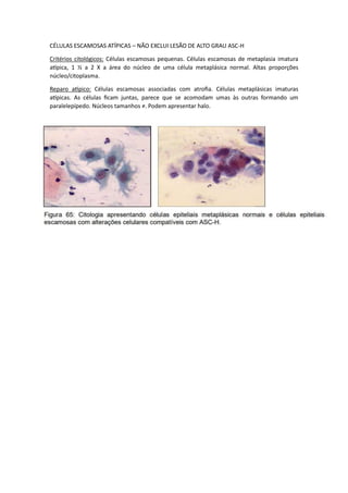 CÉLULAS ESCAMOSAS ATÍPICAS – NÃO EXCLUI LESÃO DE ALTO GRAU ASC-H
Critérios citológicos: Células escamosas pequenas. Células escamosas de metaplasia imatura
atípica, 1 ½ a 2 X a área do núcleo de uma célula metaplásica normal. Altas proporções
núcleo/citoplasma.
Reparo atípico: Células escamosas associadas com atrofia. Células metaplásicas imaturas
atípicas. As células ficam juntas, parece que se acomodam umas às outras formando um
paralelepípedo. Núcleos tamanhos ≠. Podem apresentar halo.
 
