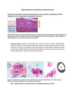 LESÃO INTRAEPITELIAL ESCAMOSA DE BAIXO GRAU (LSIL)
Citologia Células: isoladas ou agrupadas com contornos celulares nítidos. Anormalidades
nucleares em células intermediárias e superficiais. Aumento nuclear de pelo menos 3X a área do
núcleo de uma célula intermediária normal. Binucleação e multinucleação. Membrana nuclear
lisa com leves irregularidades. Célula mostrando cavidade perinuclear opticamente clara e densa
borda citoplasmática – coilócito. Paraceratose e ceratose.
Obs:. Coilócito refere-se ao espaço branco no citoplasma proximo ao nucleo.
 