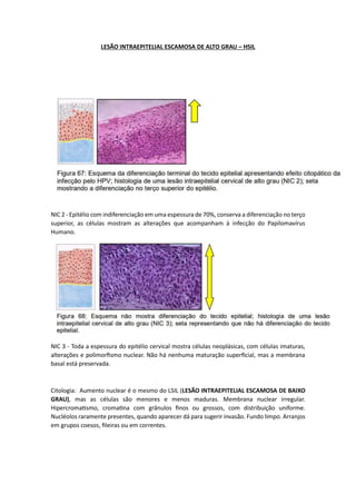 LESÃO INTRAEPITELIAL ESCAMOSA DE ALTO GRAU – HSIL
NIC 2 - Epitélio com indiferenciação em uma espessura de 70%, conserva a diferenciação no terço
superior, as células mostram as alterações que acompanham à infecção do Papilomavírus
Humano.
NIC 3 - Toda a espessura do epitélio cervical mostra células neoplásicas, com células imaturas,
alterações e polimorfismo nuclear. Não há nenhuma maturação superficial, mas a membrana
basal está preservada.
Citologia: Aumento nuclear é o mesmo do LSIL (LESÃO INTRAEPITELIAL ESCAMOSA DE BAIXO
GRAU), mas as células são menores e menos maduras. Membrana nuclear irregular.
Hipercromatismo, cromatina com grânulos finos ou grossos, com distribuição uniforme.
Nucléolos raramente presentes, quando aparecer dá para sugerir invasão. Fundo limpo. Arranjos
em grupos coesos, fileiras ou em correntes.
 