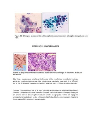 CARCINOMA DE CÉLULAS ESCAMOSAS
Obs: Toda a espessura do epitélio cervical mostra células neoplásicas, com células imaturas,
alterações e polimorfismo nuclear. Não há nenhuma maturação superficial, E AS CÉLULAS
NEOPLÁSICAS ROMPEM A MEMBRANA BASAL E INVADEM O TECIDO CONJUNTIVO SUBJACENTE.
Citologia: Células menores que as de HSIL, com características de HSIL. Acentuada variação no
tamanho e forma celular. Células em forma caudadas. Células em forma fusiformes. Formações
em pérolas córneas. Descamação em células isoladas ou agrupadas. Células em agregados
sinciciais (amontoadas) com bordas celulares mal definidas. Células escamosas com citoplasma
denso orangeofílico (amarelo) – queratinizadas.
 