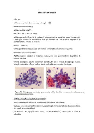 CÉLULAS GLANDULARES
ATÍPICAS
Células endocervicais (Sem outra especificação - NOS)
Células endometriais (NOS)
Células glandulares (NOS)
CÉLULAS GLANDULARES ATÍPICAS
Células mostrando diferenciação endocervical ou endometrial com atipia nuclear que excedam
a alterações reativas ou reparatórias, mas que carecem de características inequívocas de
adenocarcinoma “in situ” ou invasivo.
Critérios citológicos:
Células glandulares endocervicais com núcleos aumentados e levemente irregulares
Citoplasma vacuolizado e denso
Modificações que excedem as mudanças reativas, mas sutis que impedem o diagnóstico de
displasia glandular
Critérios citológicos: Células ocorrem em camadas, blocos ou rosetas. Sobreposição nuclear.
Variação no tamanho e forma nuclear. Leve a moderada hipercromasia. Nucléolos
ADENOCARCINOMA ENDOCERVICAL “IN SITU”
Carcinoma de células do epitélio simples cilíndrico no canal endocervical
Citologia: Aumento nuclear, hipercromasia, estratificação (várias camadas) e atividade mitótica,
sem invadir a membrana basal
Características dos agrupamentos: roseta, pseudoestratificação, sobreposição e perda da
polaridade
 