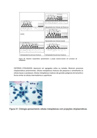 CRITÉRIOS CITOLOGICOS: Aparecem em agregados soltos ou isoladas. Mostram processos
citoplasmáticos proeminentes. Células metaplásicas imaturas são pequenas e semelhantes às
células basais e parabasais. Células metaplásicas maduras são grandes poligonais de tamanho e
forma similar às células intermediárias e superficiais
 