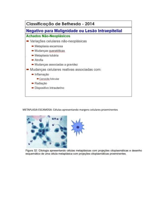 METAPLASIA ESCAMOSA: Células apresentando margens celulares proeminentes
 