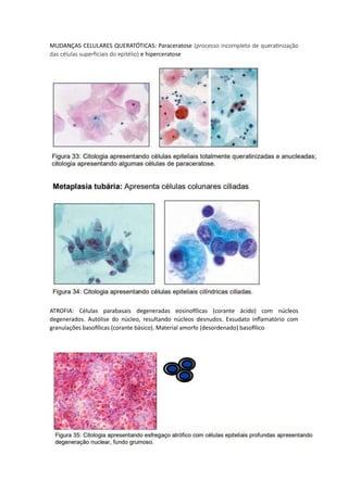 MUDANÇAS CELULARES QUERATÓTICAS: Paraceratose (processo incompleto de queratinização
das células superficiais do epitélio) e hiperceratose
ATROFIA: Células parabasais degeneradas eosinofílicas (corante ácido) com núcleos
degenerados. Autólise do núcleo, resultando núcleos desnudos. Exsudato inflamatório com
granulações basofílicas (corante básico). Material amorfo (desordenado) basofílico
 
