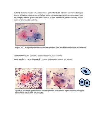 NÚCLEO: Aumento nuclear Células escamosas apresentando 1 ½ a 2 vezes o tamanho do núcleo
de uma célula intermediária normal Calibrar o olho com as outras células intermediárias normais
do esfregaço Células glandulares endocervicais podem apresentar grande aumento nuclear
(núcleos volumosos) e nucléolos
HIPERCROMATISMO - cromatina fortemente corada, mas uniforme
BINUCLEAÇÃO OU MULTINUCLEAÇÃO - Célula apresentando dois ou três núcleos
 