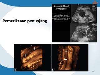 Pemeriksaan penunjang
15
 