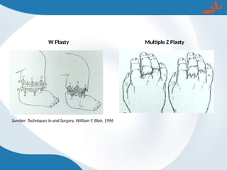 W Plasty Multiple Z Plasty
Sumber: Techniques in and Surgery, William F. Blair, 1996
 