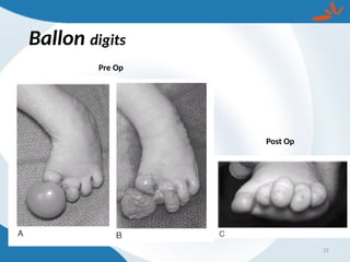 Ballon digits
21
Pre Op
Post Op
 