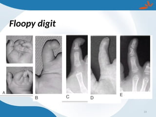 Floopy digit
23
 