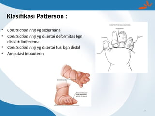Klasifikasi Patterson :
• Constriction ring yg sederhana
• Constriction ring yg disertai deformitas bgn
distal ± limfedema
• Constriction ring yg disertai fusi bgn distal
• Amputasi intrauterin
7
 