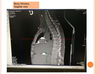 Bony Window,
Sagittal view
 