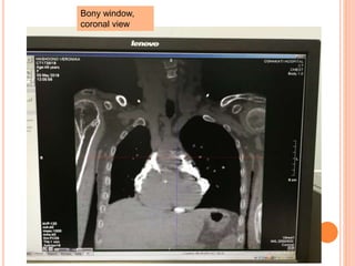 Bony window,
coronal view
 