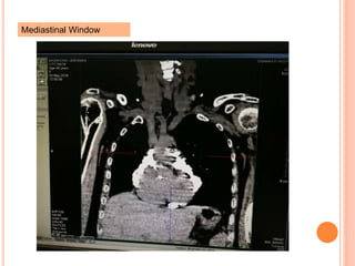 Mediastinal Window
 