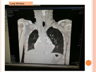 Lung Window
 