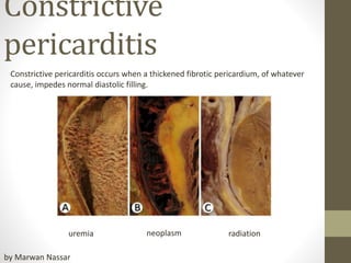 Constrictive
pericarditis
Constrictive pericarditis occurs when a thickened fibrotic pericardium, of whatever
cause, impedes normal diastolic filling.
uremia neoplasm radiation
by Marwan Nassar
 