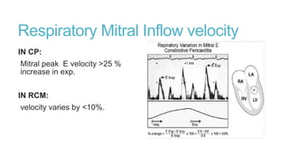 Respiratory Mitral Inflow velocity
IN CP:
Mitral peak E velocity >25 %
increase in exp.
IN RCM:
velocity varies by <10%.
 