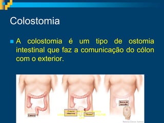 Colostomia
   A colostomia é um tipo de ostomia
    intestinal que faz a comunicação do cólon
    com o exterior.




                    Trabalho realizado por Mariana
                Liberdade Oliveira Guimarães, nº22108,
                                  UFP
 