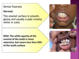 Dental fluorosis
Normal:
The enamel surface is smooth,
glossy and usually a pale creamy
white in color.
Mild: The white opacity of the
enamel of the teeth is more
extensive, but covers less than 50%
of the tooth surface.
 