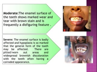 Moderate:The enamel surface of
the teeth shows marked wear and
tear with brown stain and is
frequently a disfiguring feature .
Severe: The enamel surface is badly
affected and hypoplasia is so marked
that the general form of the tooth
may be affected. There are
pitted/worn out areas and
widespread brownish discoloration
with the teeth often having a
corroded appearance.
 