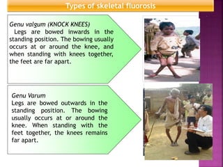 Genu valgum (KNOCK KNEES)
Legs are bowed inwards in the
standing position. The bowing usually
occurs at or around the knee, and
when standing with knees together,
the feet are far apart.
Genu Varum
Legs are bowed outwards in the
standing position. The bowing
usually occurs at or around the
knee. When standing with the
feet together, the knees remains
far apart.
Types of skeletal fluorosis
 