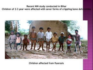 Recent NIN study conducted in Bihar
Children of 2-3 year were affected with sever forms of crippling bone deformities
Children affected from fluorosis
 