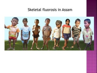 Skeletal fluorosis in Assam
 