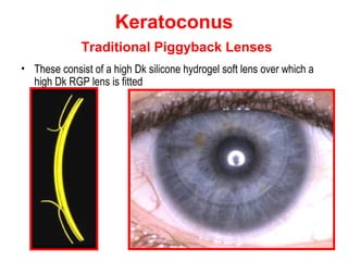 Piggyback Rgp contact lenses fitting for KCN | PPT